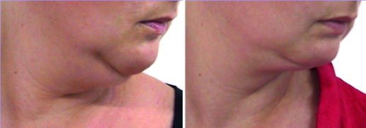 before and after treatment sessions - face comparison - chin