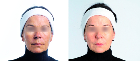 before and after treatment sessions - face comparison