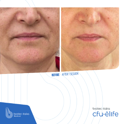 before and after treatment sessions - face comparison - cfu elife - face lines