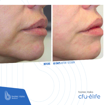 before and after treatment sessions - face comparison - cfu elife