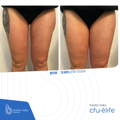 before and after treatment sessions - glutes - cfu-elife