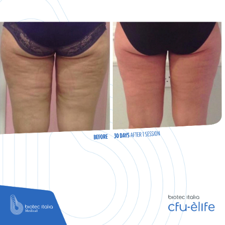 before and after treatment sessions -glutes comparison