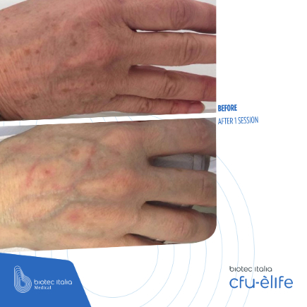 before and after treatment sessions - hands comparison