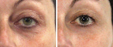 before and after treatment sessions - face comparison - eyes